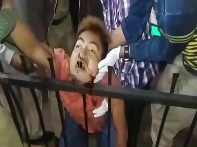 shocking accident face in steel bar