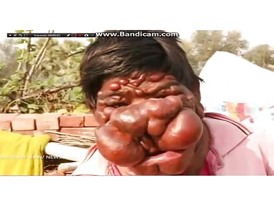 Indian boy with terrible tumor on face