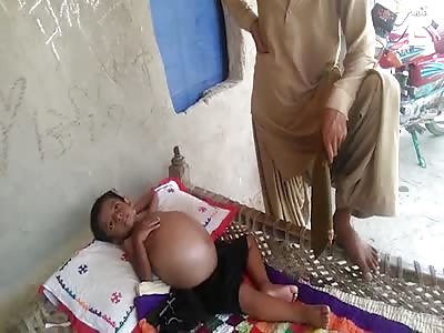 Four-year-old Pakistani boy suffering from rare disease has swollen belly the size of beach ballÂ Â 