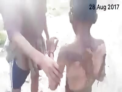 Muslim boy was burned
