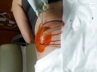Stomach churning footage shows Woman giant Ass Abscess being Drained