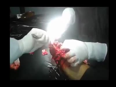  Severely damaged hand amputation in process