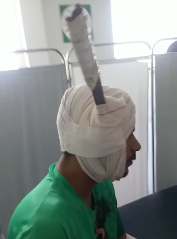 Man with Giant Knife Stuck in his Head