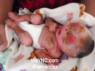 Woman gives birth to twins arlequin in turkey