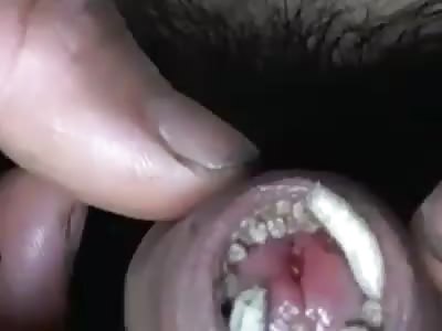 Man with larvae on his penis