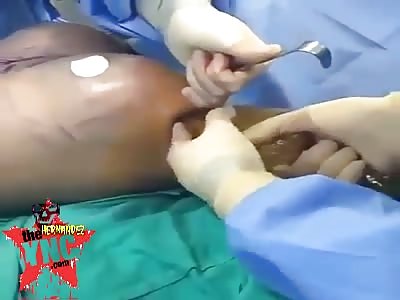 Removing silicon from buttocks