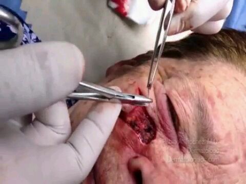 Skin cancer surgery