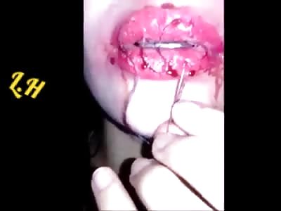 Crazy sutures the lips