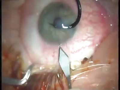 Fish Hook Removed From Eye.