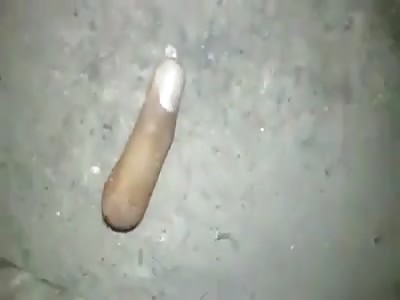 Man lost his finger