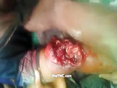 Youths Arm Got Torn Up By a Soldiers Bullet