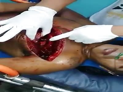 Man With Chest Sliced Wide Open by Machete
