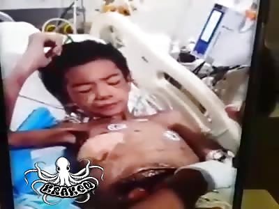 Brutal case of Aplastic anemia