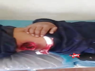 casualties caused by bullets from SDF terrorists