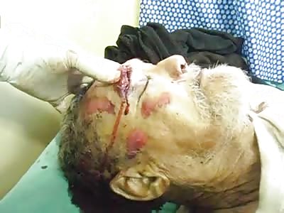 Man dies by strong blow to the head and the forensic doctor puts his finger in the wound