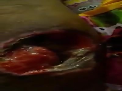 shocking video! Severe exposed wounds, caused by electric shock wtf