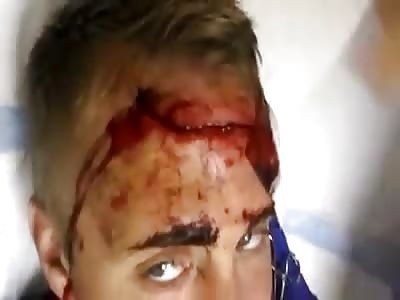 suturing a huge head wound