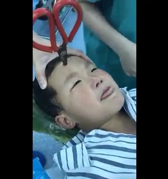Short video shows Boy with a Scissors embedded on his Forehead