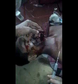 Muslim boy with mouth disfigured agonizes after to receives shot  
