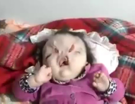 Little girl with horrible malformation on her face