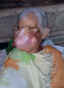 Elderly woman unrecognizable face ( cancer Tumor)