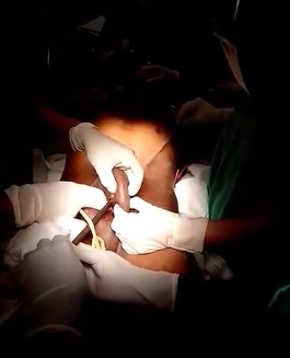 Man Impaled Through his Penis and Stomach is Helped by Doctors