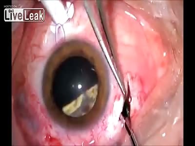 Removing a piece of glass in the eye