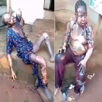 He Accused His Wife of Infidelity and Set Her on Fire, the Wife Hugs Him and They Both Burnt to this Level
