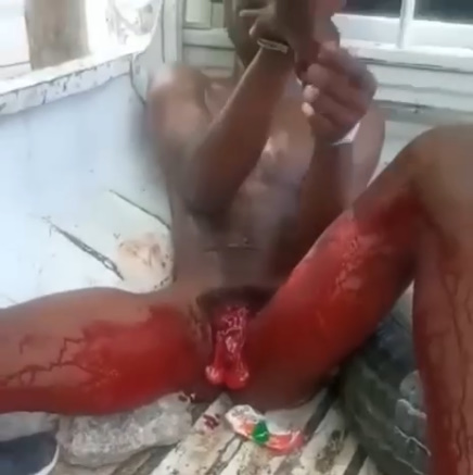 Deranged Man Cuts Off His Own Penis after Stabbing Girlfriend.