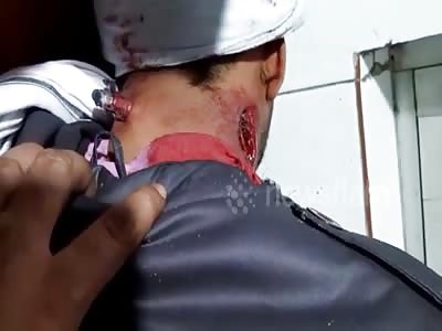 Miraculously survive as bullet shot in neck...