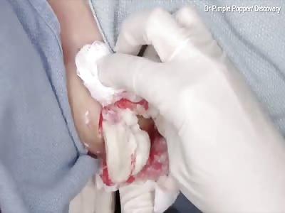 Woman gets huge cyst on her collarbone popped