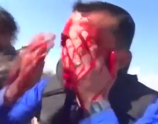 Reporter a Bloody Mess after Being Shot in the Eye during Live TV