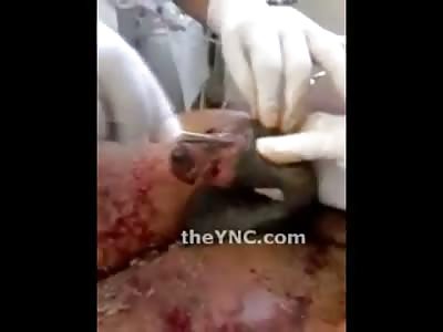 Absolutely Disgusting Video of a Man with Maggots on his Penis getting Handled by the Nurses 