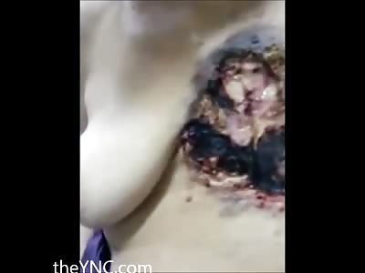 Old Woman with Horrible Wound that Consumed Her Breast