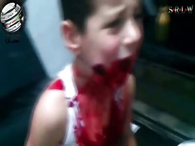 Collateral Damage: Little Boy Shot in the Face During Syrian Gun Fight