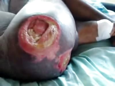 Man has a Nasty Infection on his Ass Cheek for Gods Sake
