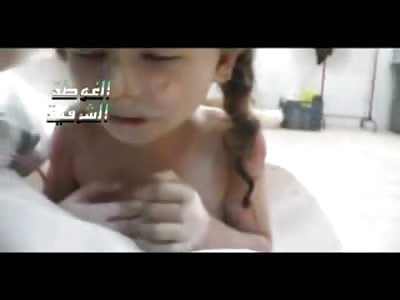 Painful Video to Watch shows a Girl too Young Brutally Burned all Over