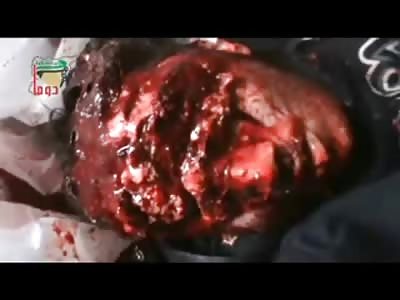 Shocking Video showd Man with No Face still Reflex Breathing 