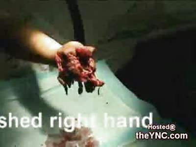 Man's Crushed Right Hand