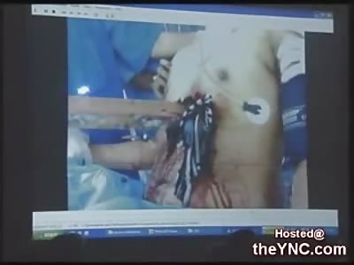 Man with a 9 Foot Pole through his Chest Survives