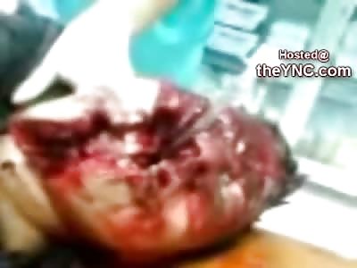 True HORROR: Doctors try to Intubate a Panicking, Gasping Man with Face Blown Off (Video is Graphic)