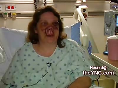 Woman Attacked by Pitbull for Stepping on the Pitbull Puppy tells Her Story