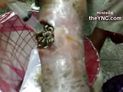 Nurses gather to see Man with Maggot Infested Infected Leg