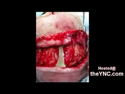 Subgaleal Absess into Nasal Cavity is Drained through the Back of the Brain (Very Graphic Video)