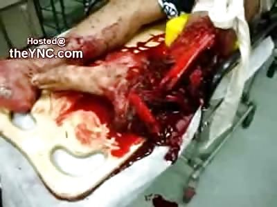 Possibly the most Gruesome Leg Trauma Ive Ever Seen