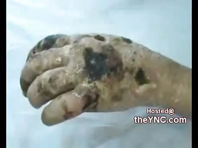Heroin Junkies Horribly Infected Hand From Needle use
