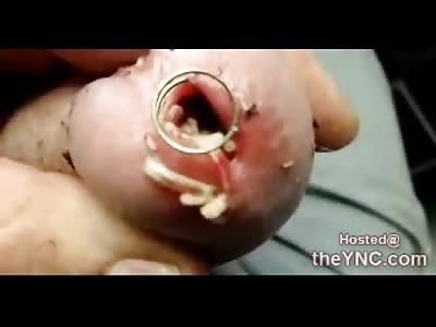 OMG: Man with Disgusting Infected and Swollen Maggot Infested Penis