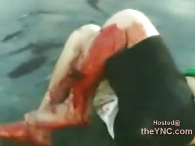 Man Squirming with Gruesome Tibia Compound Fracture and a Flopping Leg