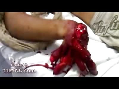 Blood still Glistening on Possibly the Worst Blown Off Hand Ever (Very Up Close Footage)
