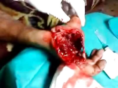 Doctor shows off Mans Hand with a HUGE Hole in It